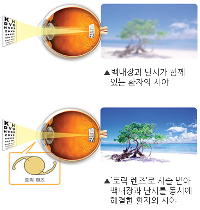 백내장과 난시교정