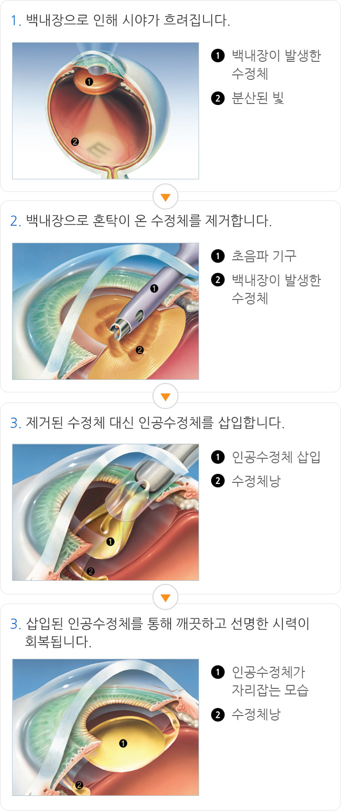 백내장 수술과정